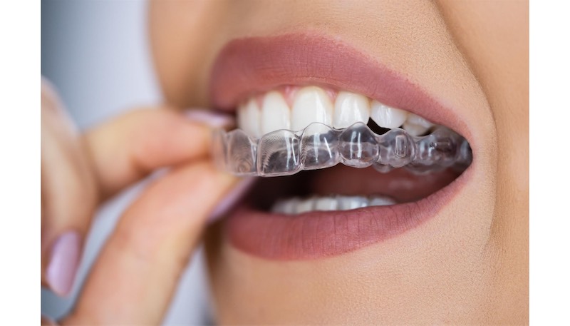 SureSmile clear aligners at Harrison Family Dentistry in Chattanooga, TN