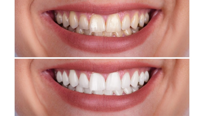 Professional teeth whitening results at Harrison Family Dentistry in Chattanooga, TN