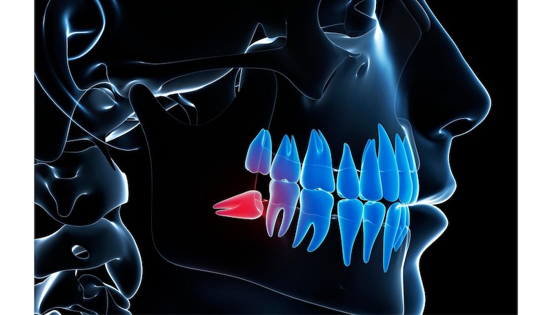 Wisdom teeth removal by Dr. Fitzhugh at Harrison Family Dentistry in Chattanooga, TN